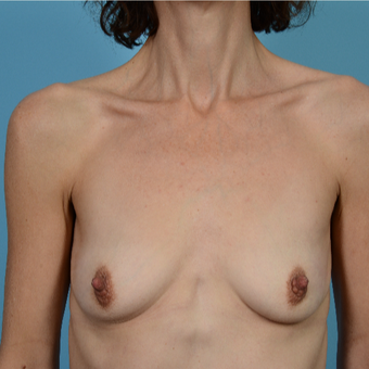 45-54 year old woman treated with Breast Augmentation/Peri-Areolar Incision before 3089477