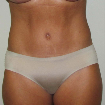 Tummy Tuck for This 45 Year Old Woman after 3384967