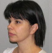 46 year old woman treated with Facelift after 3282889