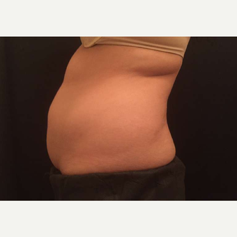 25-34 year old woman treated with CoolSculpting before 3747825