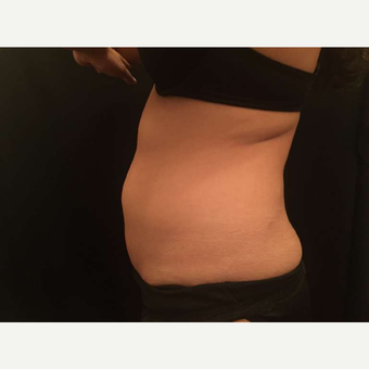 25-34 year old woman treated with CoolSculpting after 3747825