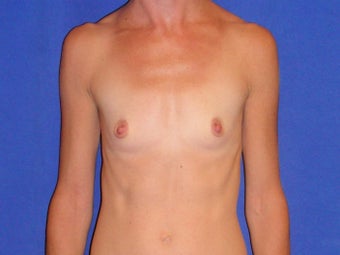 Breast Augmentation before 1189546