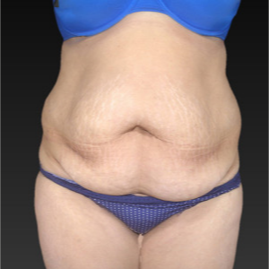 45-54 year old woman treated with Tummy Tuck before 3743631