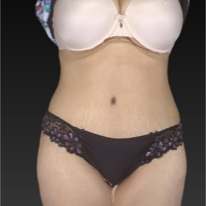 45-54 year old woman treated with Tummy Tuck after 3743631