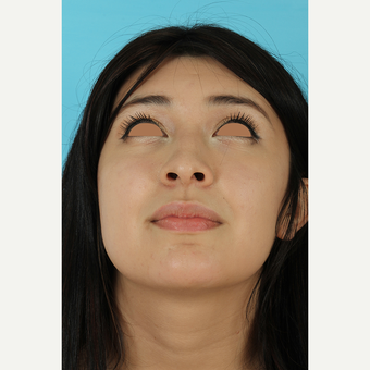 25-34 year old woman treated with Rhinoplasty before 3691305