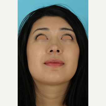 25-34 year old woman treated with Rhinoplasty after 3691305