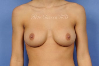 21 Year Old Breast Augmentation before 899437