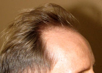 FUE ARTAs robotic hair transplantation before 1097635