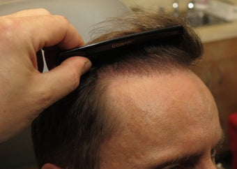 FUE ARTAs robotic hair transplantation after 1097635