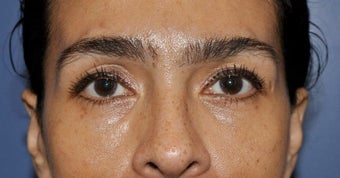 Lower lid blepharoplasty and Fat Transfer to lower lids and midface after 307123