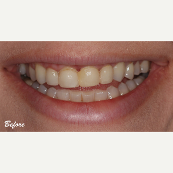 35-44 year old woman treated with Porcelain Veneers before 3578296