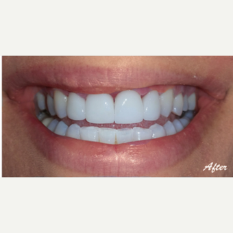35-44 year old woman treated with Porcelain Veneers after 3578296