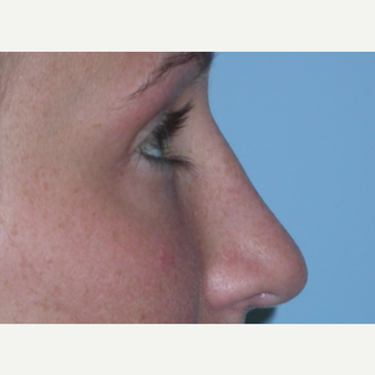 18-24 year old woman treated with Rhinoplasty after 3075851