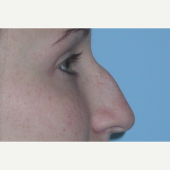 18-24 year old woman treated with Rhinoplasty before 3075851