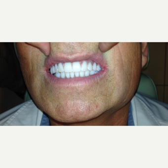 45-54 year old man treated with All-on-4 Dental Implants after 3320553