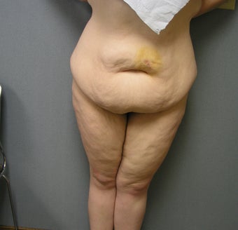 36 year old Requesting Body Lift After 100 lb. Weight Loss before 1012374