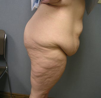 36 year old Requesting Body Lift After 100 lb. Weight Loss 1012374