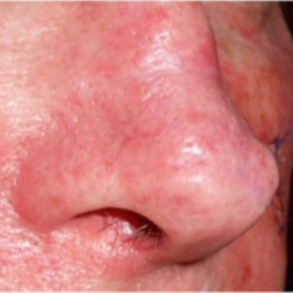 65-74 year old man treated with Pulsed Dye Laser for broken blood vessels on nose after 3183911