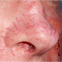 65-74 year old man treated with Pulsed Dye Laser for broken blood vessels on nose before 3183911
