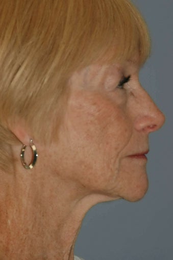 68 year old female fat grafting to the face 1236754