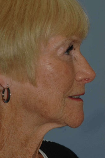 68 year old female fat grafting to the face 1236754