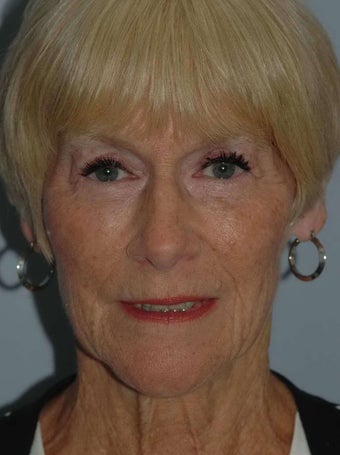 68 year old female fat grafting to the face after 1236754