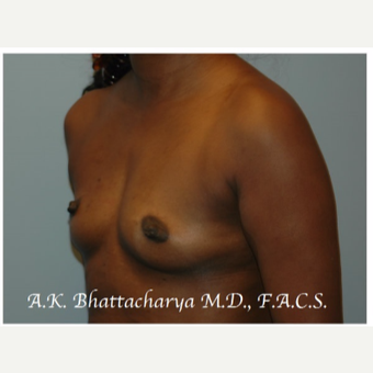 35-44 year old woman treated with Breast Augmentation before 3621993