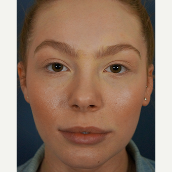 18-24 year old woman treated with Lip Augmentation after 3244977