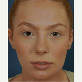 18-24 year old woman treated with Lip Augmentation before 3244977