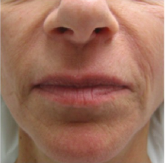 35-44 year old woman treated with Liquid Facelift before 2467612