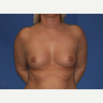 25-34 year old woman treated with Breast Augmentation before 3219911
