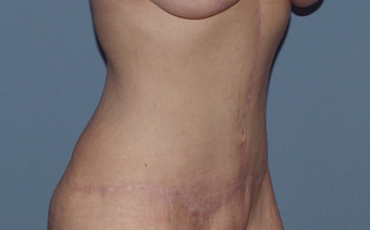 The "Fleur-de-lys" tummy tuck (abdominoplasty) after 845700