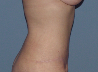 The "Fleur-de-lys" tummy tuck (abdominoplasty) 845700