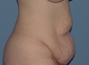 The "Fleur-de-lys" tummy tuck (abdominoplasty) 845700