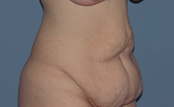 The "Fleur-de-lys" tummy tuck (abdominoplasty) before 845700