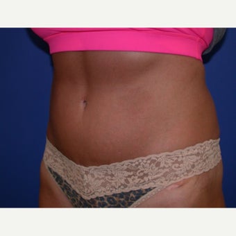 Tummy Tuck 1608073