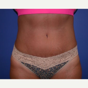 Tummy Tuck after 1608073