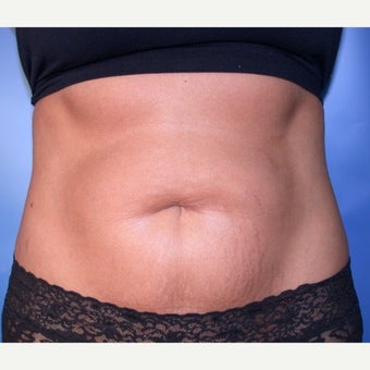 Tummy Tuck before 1608073