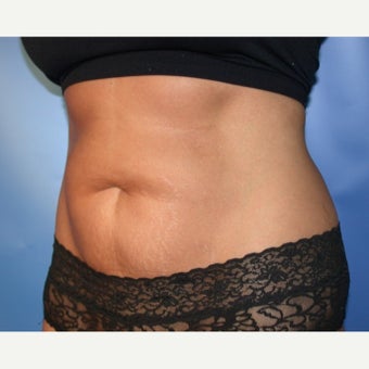 Tummy Tuck 1608073