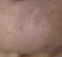 Botox for pebble chin after 91300