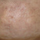 Botox for pebble chin before 91300