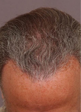 54 year old man treated with Hair Transplant after 1647714