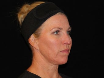 45-54 year old woman treated with Non Surgical Face Lift 3502136