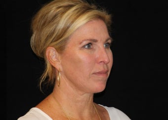 45-54 year old woman treated with Non Surgical Face Lift 3502136