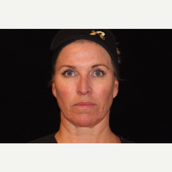 45-54 year old woman treated with Non Surgical Face Lift before 3502136