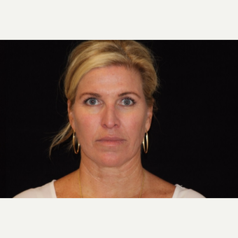 45-54 year old woman treated with Non Surgical Face Lift after 3502136