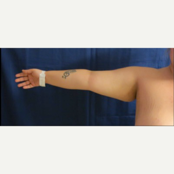 25-34 year old woman treated with Laser Liposuction before 3831715