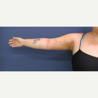 25-34 year old woman treated with Laser Liposuction after 3831715