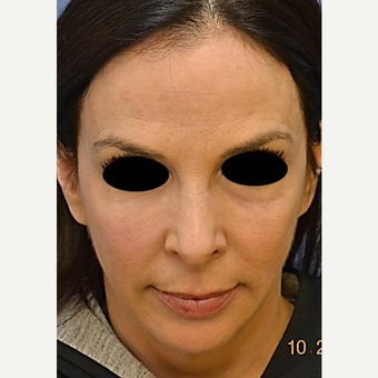 45-54 year old woman treated with Profound RF after 3689782