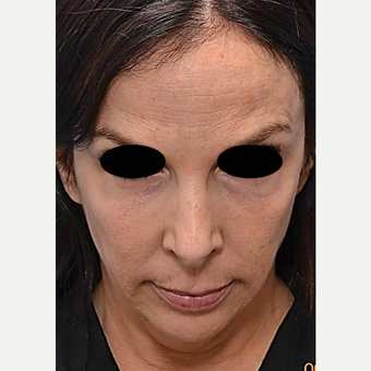 45-54 year old woman treated with Profound RF before 3689782